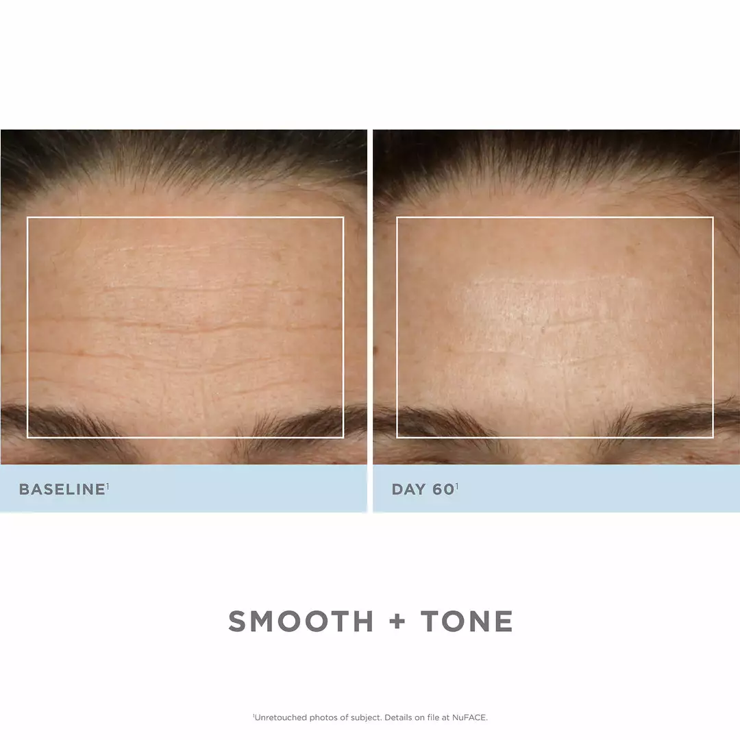 NuFACE Trinity Pro Facial Toning Complete Kit 7 NuFACE Trinity Pro Facial Toning Complete Kit