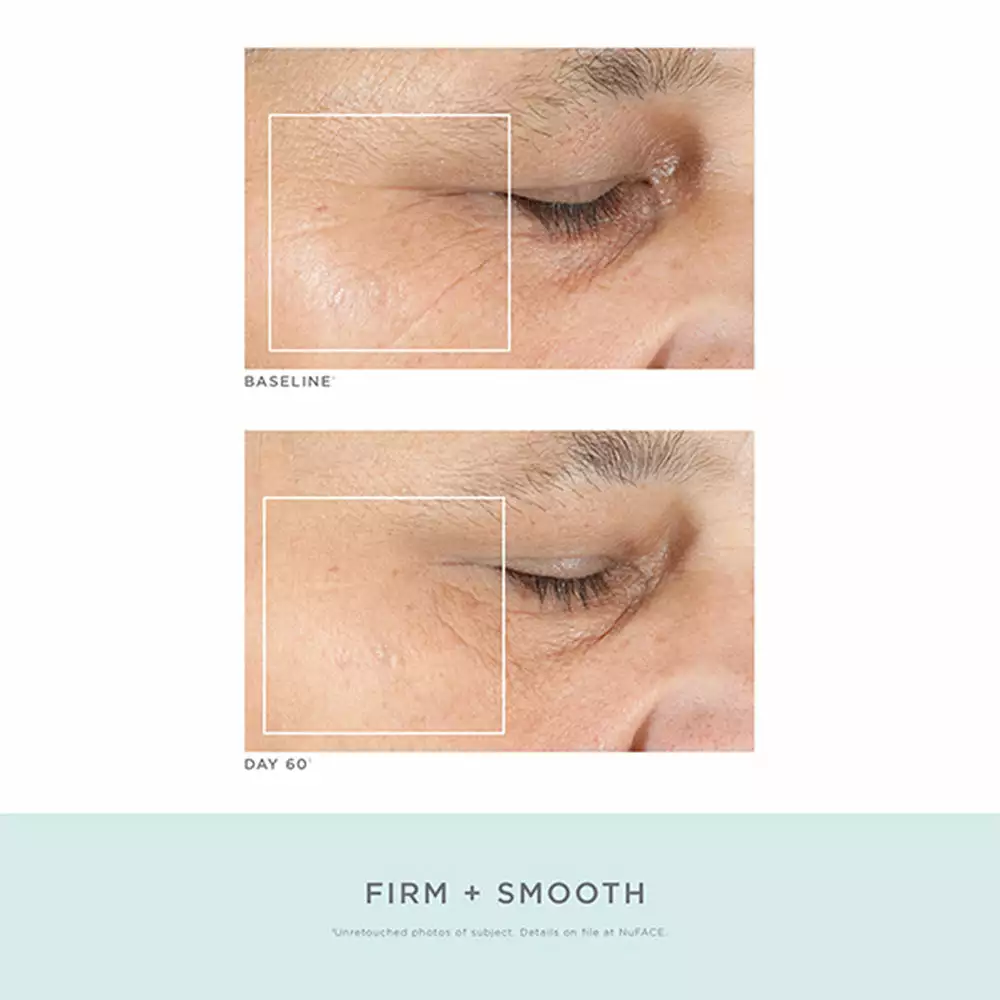 NuFACE Trinity Pro Facial Toning Kit + ELE 8 NuFACE Trinity Pro Facial Toning Kit + ELE