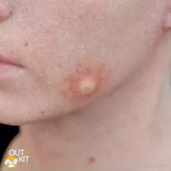 Special FX Out Of Kit Insect Bite (Large)